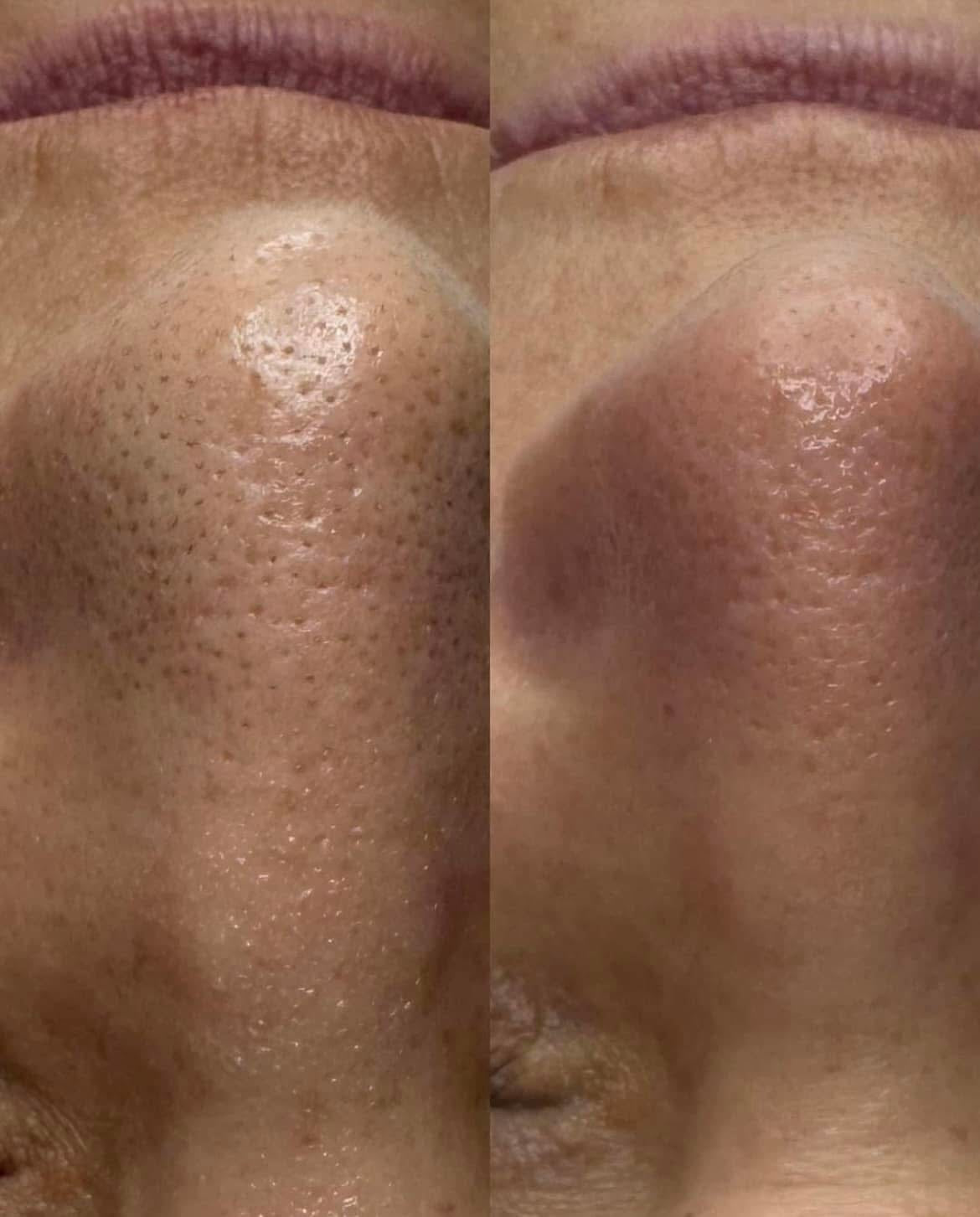 Hydra Facial