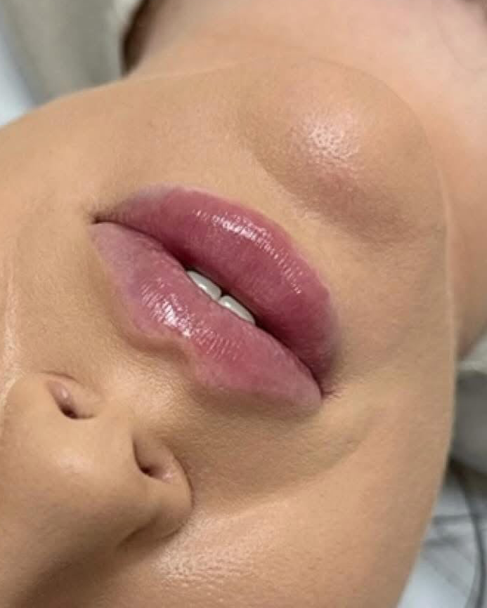Lip Filler