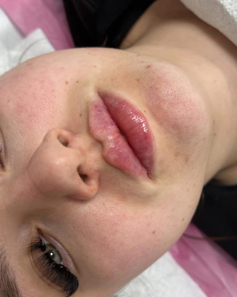 Lip Filler
